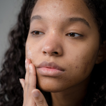 Woman looking at her acne in the mirror. 