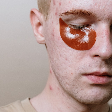 Pale looking teenage boy with quite bad acne. 